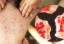 হাম ও উপসর্গে আরও ৫ শিশুর মৃত্যু, আক্রান্ত ২৮ হাজার ছাড়িয়েছে