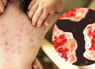 হাম ও উপসর্গে আরও ৫ শিশুর মৃত্যু, আক্রান্ত ২৮ হাজার ছাড়িয়েছে