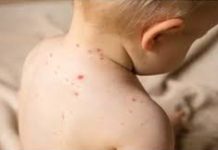 গত ২৪ঘণ্টায় হাম ও হামের উপসর্গে আরও ৫ জনের মৃত্যু