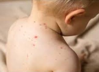 হাম ও উপসর্গ নিয়ে আরও ১১ শিশুর মৃত্যু